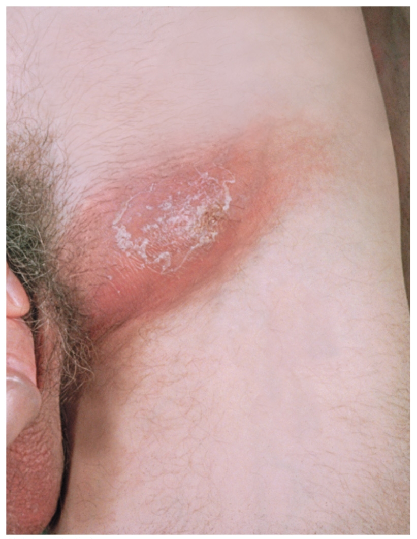 <p><span>Agent: </span><em><span>Chlamydia trachomatis</span></em></p><p><span style="background-color: transparent;"><span>(Asymptomatic in women) Damage to reproductive tissues can cause sterility</span></span></p><p><span style="background-color: transparent;"><span>– Pelvic inflammatory disease (PID) </span></span></p><p><span><strong><span>Lymphogranuloma venereum</span></strong><span>- transient genital </span><strong><span>lesion</span></strong><span> at the site of infection</span></span></p><p class="s15"><span><span>•Followed by development of bubo</span></span></p><p class="s87"></p>