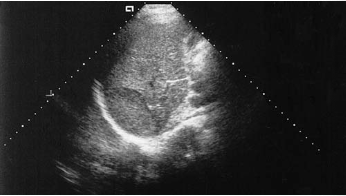 <p><span>A 30-year-old female patient presents to the ultrasound department with postprandial pain. Gallstones are identified along with a mass in the right lobe of the liver. The patient has been taking oral contraceptives for 10 years. Based on this clinical history and sonogram, the mass is most suspicious for:</span></p>