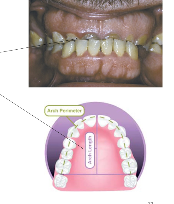 <ul><li><p class="p1"><strong><mark data-color="purple" style="background-color: purple; color: inherit;">Teeth affected:</mark></strong><mark data-color="purple" style="background-color: purple; color: inherit;"> Both deciduous and permanent</mark></p></li></ul><ul><li><p class="p1"><mark data-color="purple" style="background-color: purple; color: inherit;">Affects predominantly</mark><strong><mark data-color="purple" style="background-color: purple; color: inherit;"> opposed dental surfaces in contact</mark></strong></p></li><li><p class="p1"><strong><mark data-color="purple" style="background-color: purple; color: inherit;">Most frequent locations:</mark></strong><mark data-color="purple" style="background-color: purple; color: inherit;"> Incisal and occlusal surfaces</mark></p></li><li><p class="p1"><strong><mark data-color="purple" style="background-color: purple; color: inherit;">Characteristic finding:</mark></strong><mark data-color="purple" style="background-color: purple; color: inherit;"> Large, flat, shiny wear facets</mark></p></li><li><p class="p1"><strong><mark data-color="purple" style="background-color: purple; color: inherit;">Loss of interproximal contact points:</mark></strong><mark data-color="purple" style="background-color: purple; color: inherit;"> due to </mark><strong><mark data-color="purple" style="background-color: purple; color: inherit;">vertical movement</mark></strong><mark data-color="purple" style="background-color: purple; color: inherit;"> of teeth → leads to </mark><strong><mark data-color="purple" style="background-color: purple; color: inherit;">shortening of arch length</mark></strong></p></li><li><p class="p1">Pulp exposure and dentin sensitivity are rare</p><ul><li><p class="p1"><strong>Slow tooth structure loss</strong> allows for apposition of reparative secondary dentin within pulp cavity</p></li></ul></li></ul><p></p>