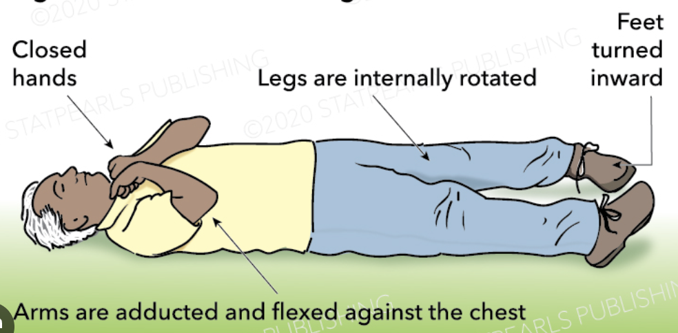 <ul><li><p>flexion in upper extremities</p></li><li><p>extension and internal rotation in lower extremities</p></li><li><p>**indicates hemispheric lesion…bleeding**</p></li></ul><p></p>