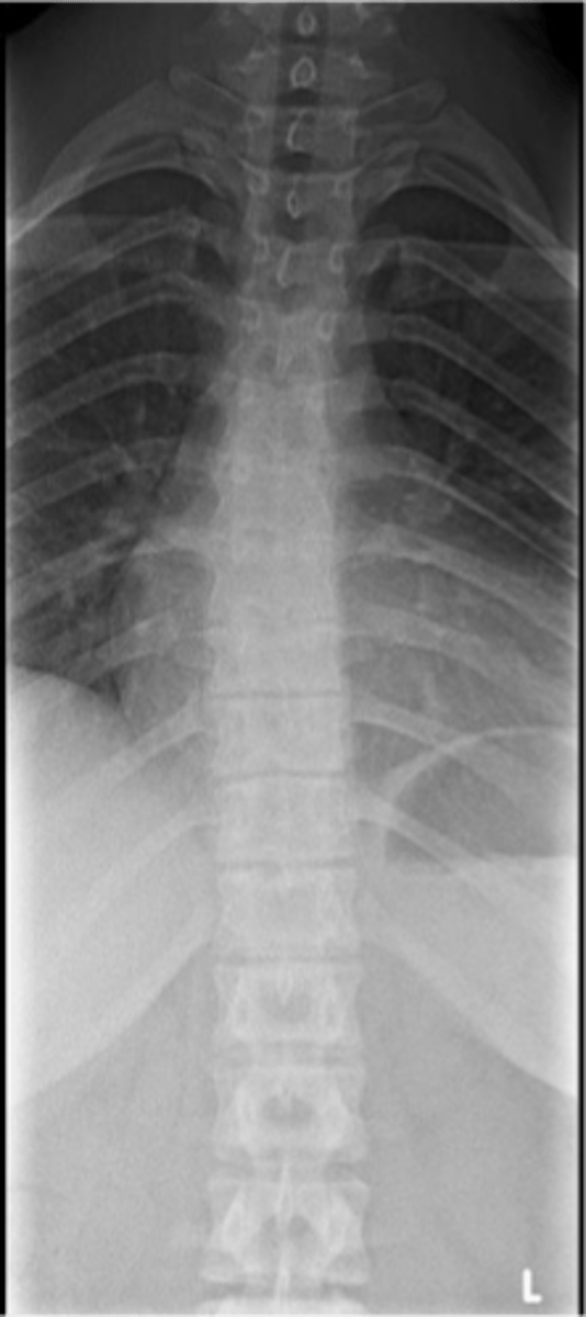 <p>Scheuermann Disease findings</p>