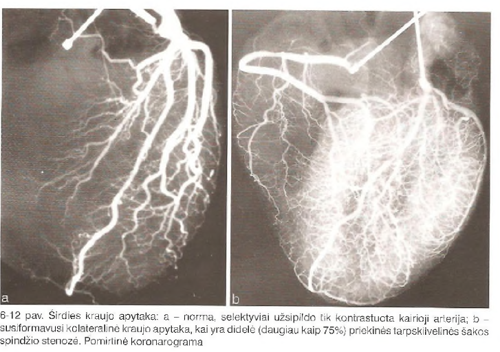 <p>Kolateralinė apytaka</p><p>Anastamozės, susiaurėjus spindžiui plečiasi virš kliūties esantis arterijos segmentas</p>