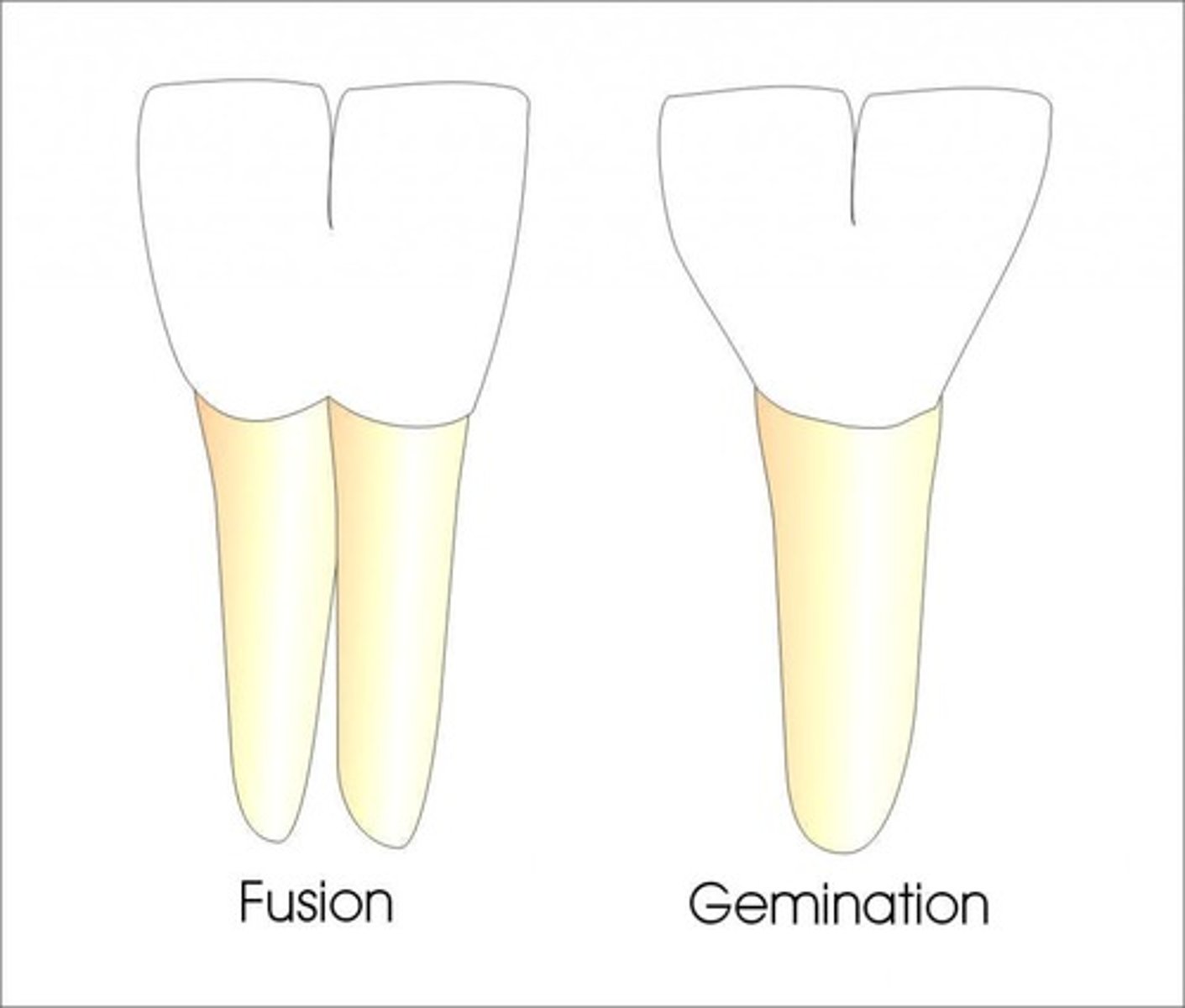 <p>Incomplete division of one tooth during development. Usually share a common root</p><p>"Twinning"</p>