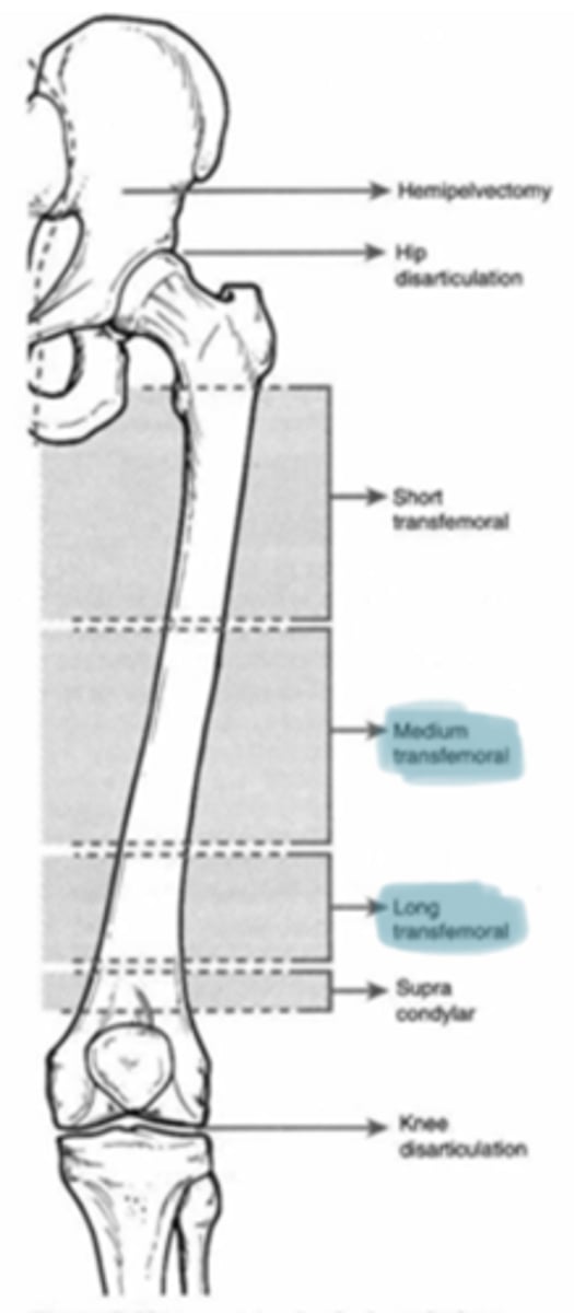 <p>Transfemoral amputation (TFA)</p>