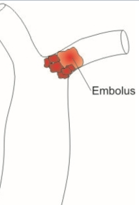<p>Embolus</p>