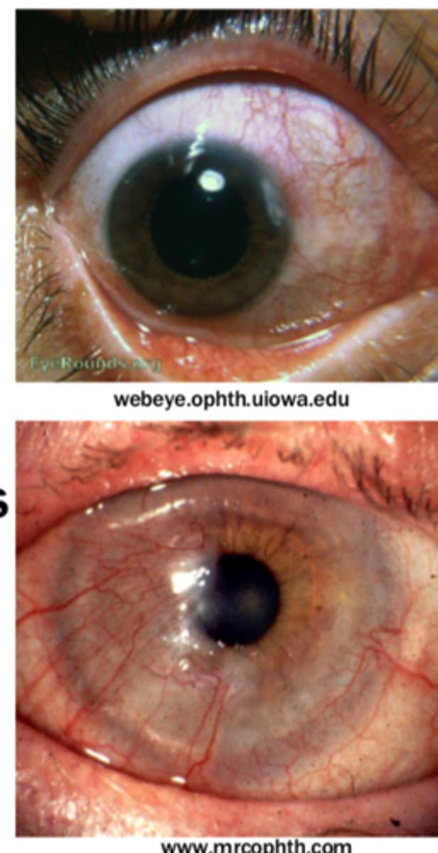 <p>a condition where the cornea becomes inflamed due to rosacea, a skin and eye condition</p>