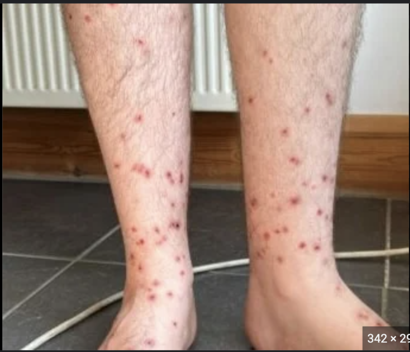 <p>bites are usually multiple and grouped, occurs on the legs or ankles with intense itching</p>