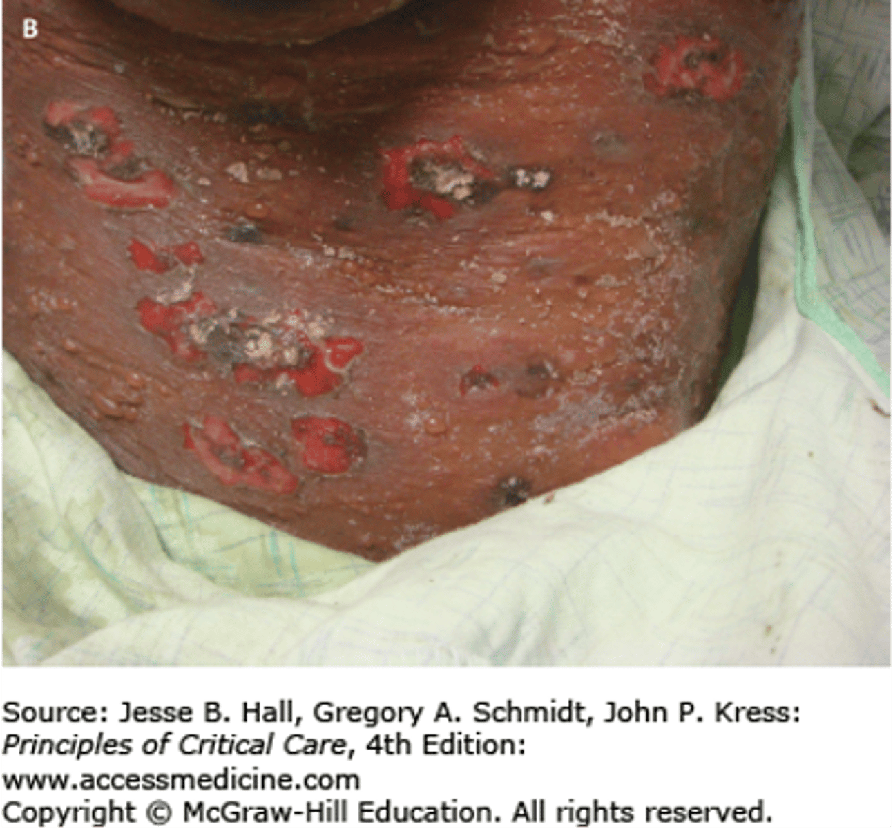 <p>Loss of the superficial epidermis, the surface is moist but does not bleed</p><p>- Ex: Rupture of a vesicle in chicken pox</p>