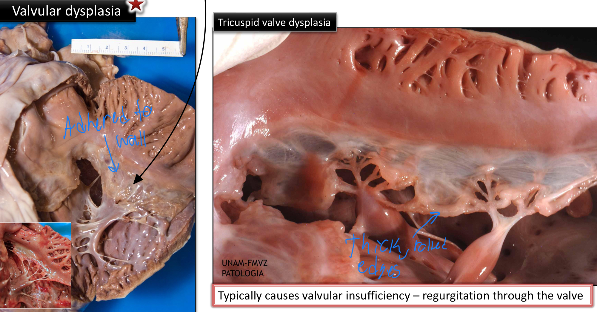<ul><li><p>Abnormal shape/appearance of the valves of the heart</p><ul><li><p>Short, thick, misshapen</p></li><li><p>Rolled edges</p></li><li><p>Absence of chordae tendineae</p></li><li><p>Fusions of leaflerts or chordae to the ventricular wall</p></li><li><p>Thick or atrophic papillary muscle</p></li></ul></li></ul><p></p>