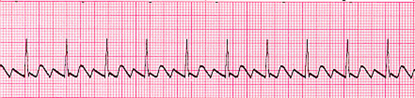 <p>sawtooth flutter waves, more regular pattern, seen with CAD and rheumatic disease</p><p>key problems: loss of atrial kick, decreased CO, and thromboembolism risk</p><p>tx: rate control or rhythm conversion by AV node slowing meds, synchronized cardioversion (prompt treatment), and anticoagulation is greater than 72 hours.</p><p>For synchronized cardioversion, pt should be NPO before procedure and receive sedation.</p><p>If needed long term management, radio frequency ablation, pacing, and implantable devices.</p><p>Flutter = regular rhythm but still high stroke risk</p>