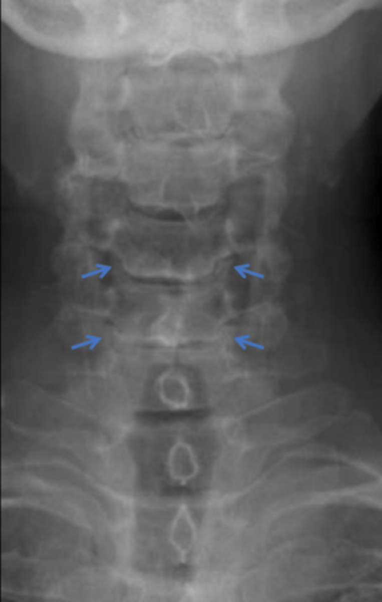 <p>- very little pain, just vague discomfort</p><p>- stiffness > pain</p><p>- NO referred or neuro symptoms</p><p>- morning stiffness</p>