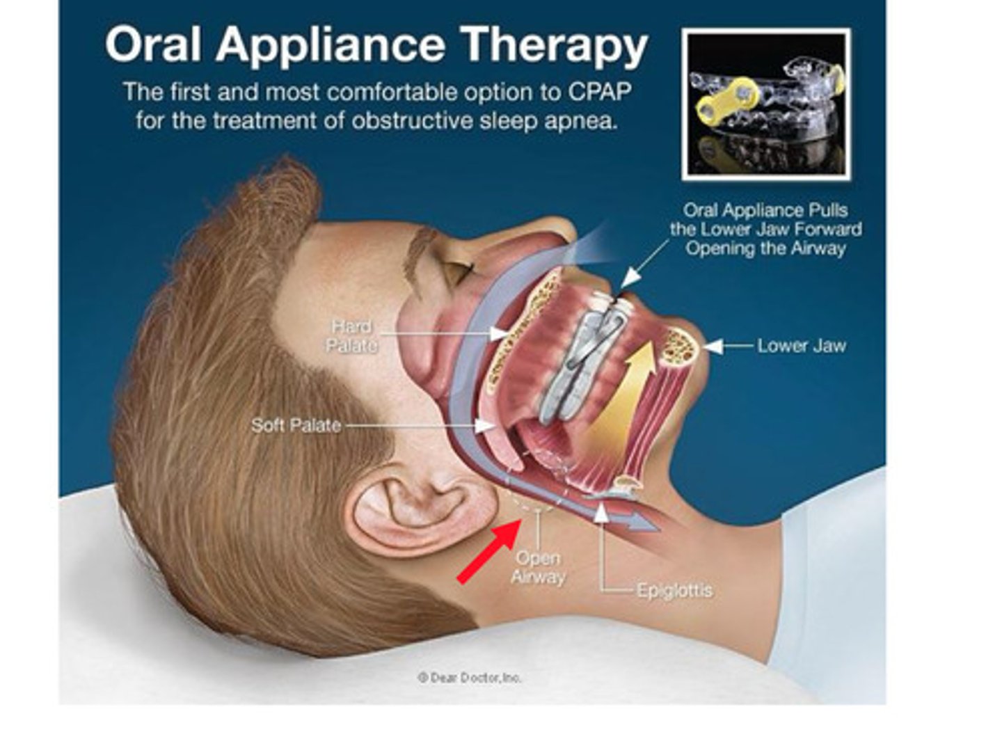 <p>This custom made oral device is indicated for sleep apnea if CPAP cannot be used. Brings mandible forward to open airway</p>