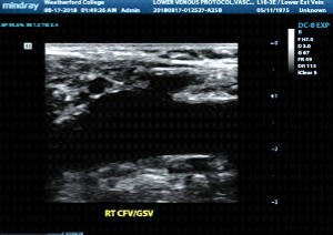 <ol><li><p>Where is the sonographer scanning in this image?</p></li><li><p>Will a thrombus here be a cause for concern?</p></li><li><p>If yes, why is that?</p></li></ol><p></p>