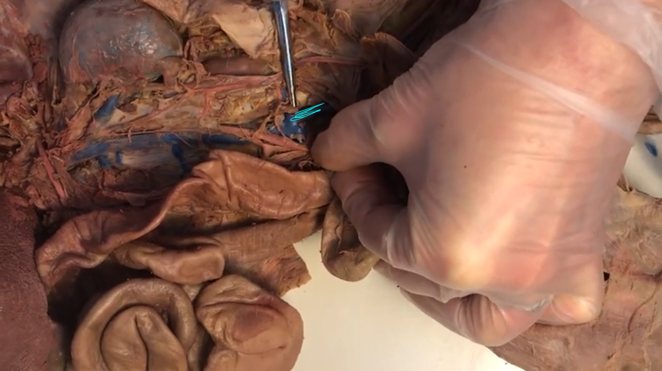 <p>What vein is this</p>