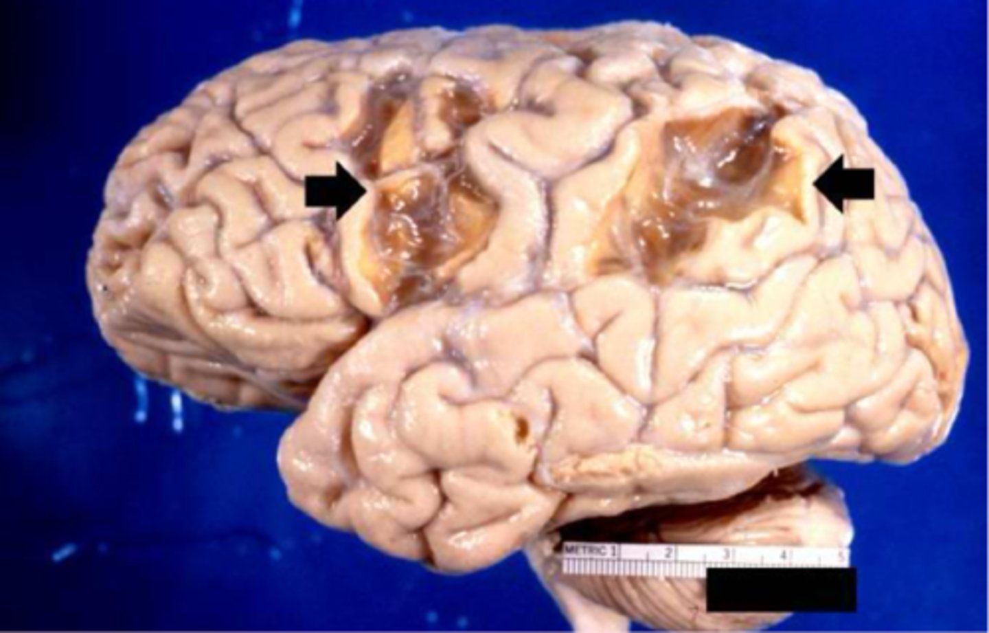 <p>golden brown, depressed, may resolve as shrunken pale scars</p>