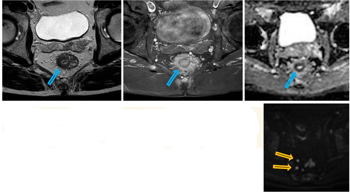 <p>Patient history: bloody stool, colonoscopy showed high-grade rectal adenocarcinoma, staging MRI </p><p>Modality: pelvis, axial views</p><p>Region: T2W MRI (left), T1 fatsat contrast-enhanced MR (middle) after iv. gadolinium, ADC map MRI (right); DWI (lower) </p><p> Radiologic sign: semicircular thickened rectal wall with moderate contrast enhancement and concomitant restricted diffusion (blue arrows), enlarged locoregional lymph nodes with restricted diffusion (yellow arrows) </p><p>Diagnosis: rectal adenocarcinoma</p>
