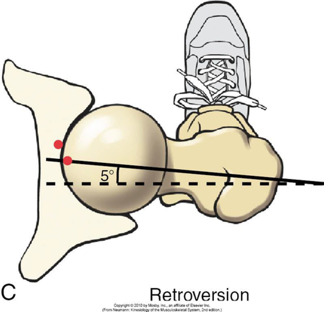 <p>LESSER angle of torsion than expected for age</p><p>*involves femoral head/neck and shaft</p>
