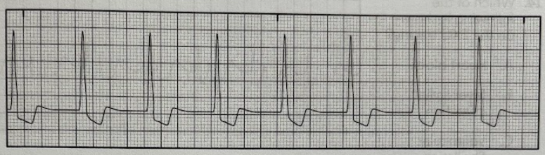 <p>Using the EKG tracing, identify the cardiac rhythm.<br>A. Atrial rhythm</p><p>B. Junctional rhythm</p><p>C. Sinus rhythm</p><p>D. Ventricular rhythm</p>
