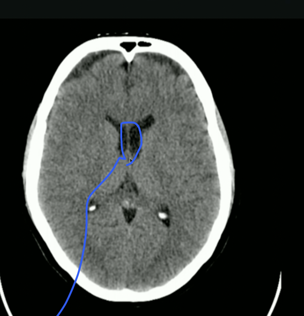 <p>What is in between Lat. Ventricles?</p>