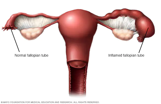 <p>Pelvic Inflammatory Disease</p>