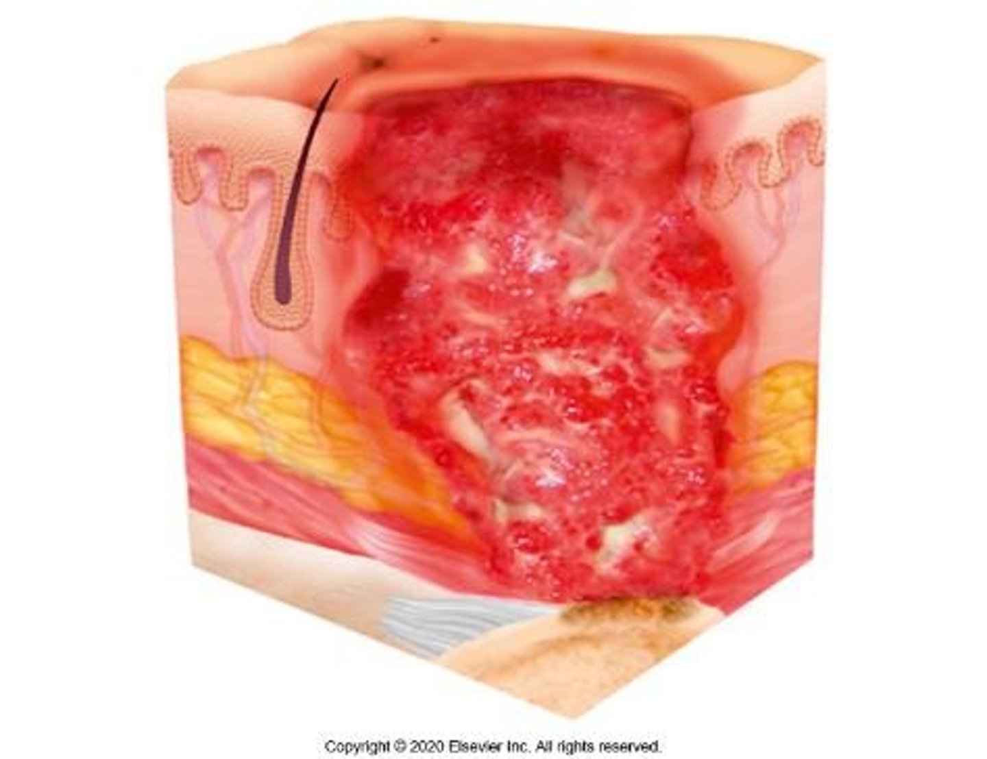<p>Full-thickness skin and tissue loss; deep injury with exposed or palpable fascia, muscle, tendon, ligament or cartilage, or bone; slough of eschar may be visible.</p>