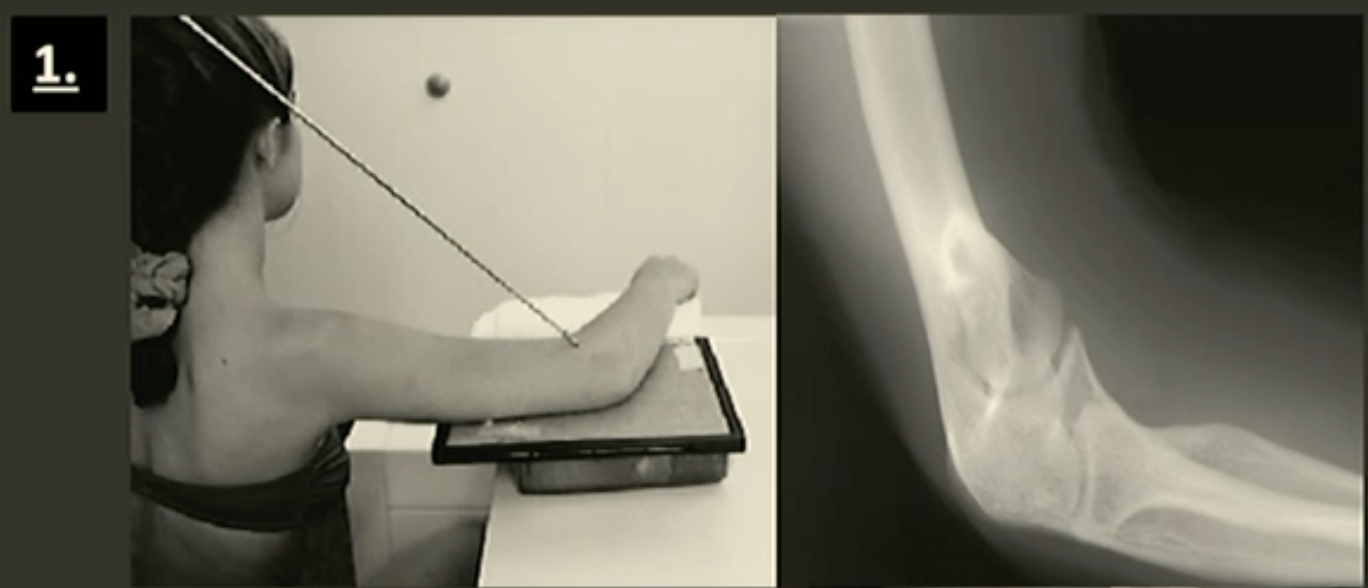 <p>Fine FS, 100cm</p><p>60kVp/3mAs</p><p>Tube angle 35-45 degrees away from humerus</p><p>CR: 1cm anterior to elbow joint</p>