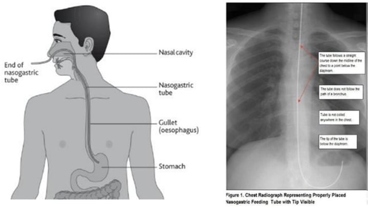 <p>Initial placement checked by X-ray<br>-Subsequent placement checked by aspirating stomach contents</p>