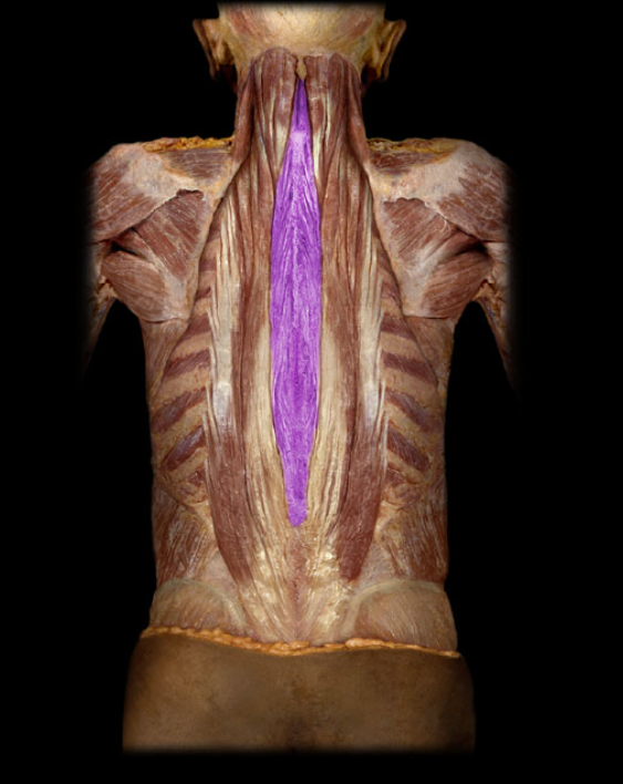 <ul><li><p>Action: Unilateral: lateral flexion of vertebral column, Bilateral: extension of vertebral column</p></li><li><p>Origin: Spinous processes and nuchal ligament</p></li><li><p>Insertion: Spinous processes (cervical and thoracic) and occipital bone</p></li><li><p>Innervation: Dorsal rami of spinal nerves</p></li></ul><p></p>