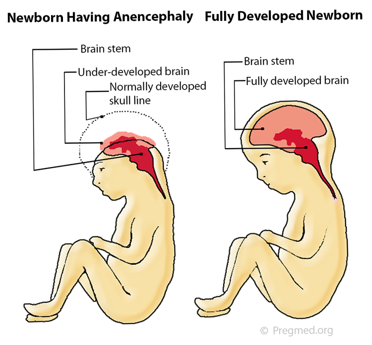 <ul><li><p>Birth defect where the baby is born without parts of head or skull fully formed. </p></li><li><p>type of neural tube defect (NTD)</p></li><li><p>as the neural tube forms and closes, it helps form the baby’s brain and skull (the upper part of the neural tube), spinal cord, and backbones (lower part of neural tube)</p></li><li><p>symptoms are underdeveloped skull and unconciousness</p></li><li><p>life expectancy of few hours to few days after birth</p></li><li><p>no cure</p></li></ul>