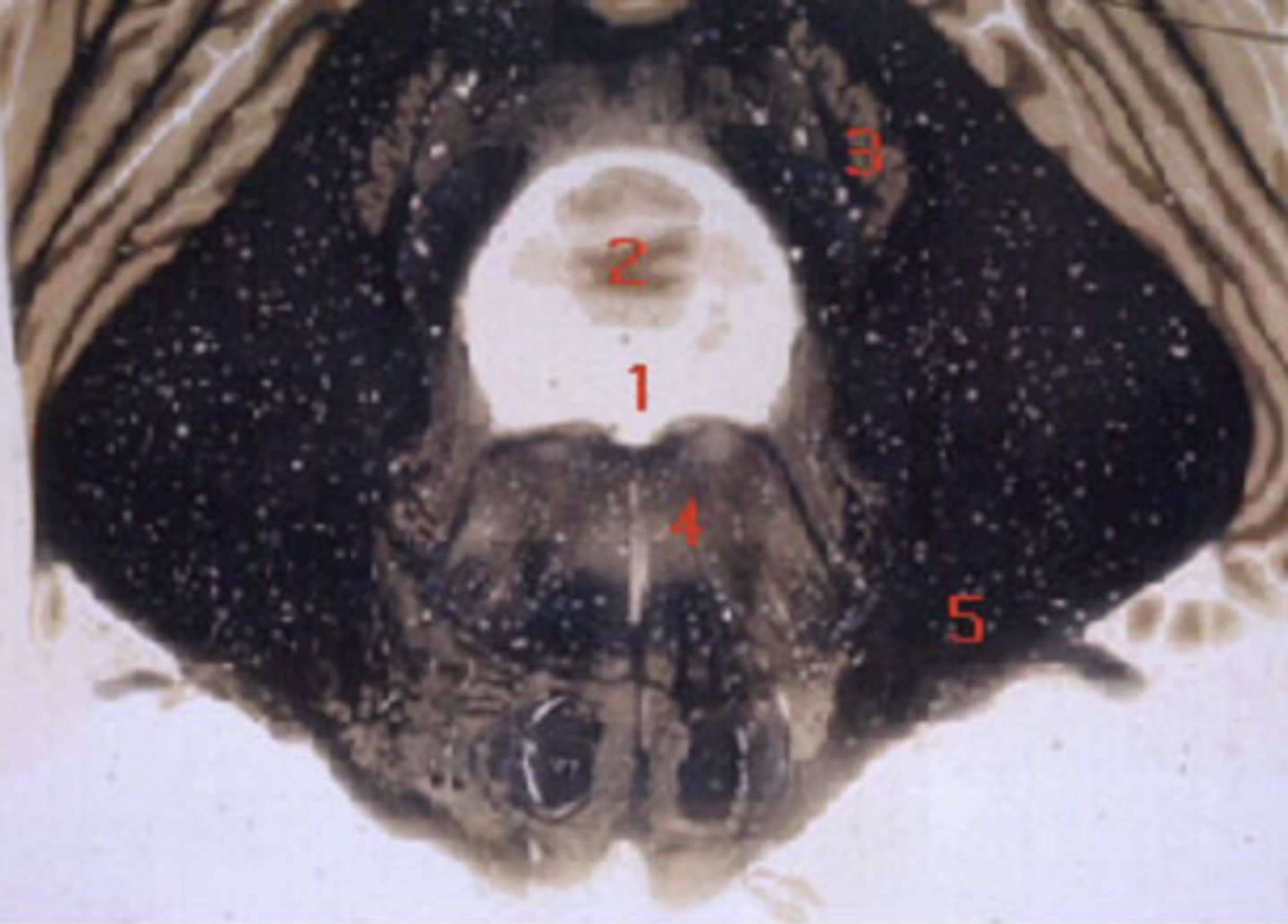 <p>middle cerebellar peduncle</p>