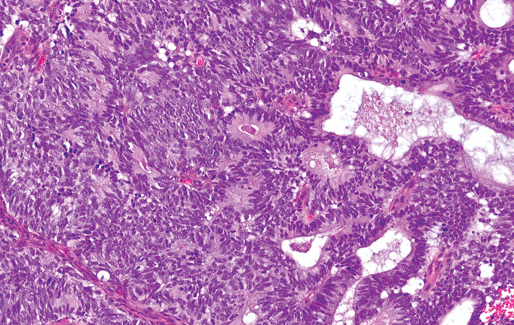 <p>Patient jeune avec tumeur au niveau de la lame criblée </p><p>1) Diagnostic</p><p>2) Localisation</p><p>3) Histologie</p><p>4) IHC </p>