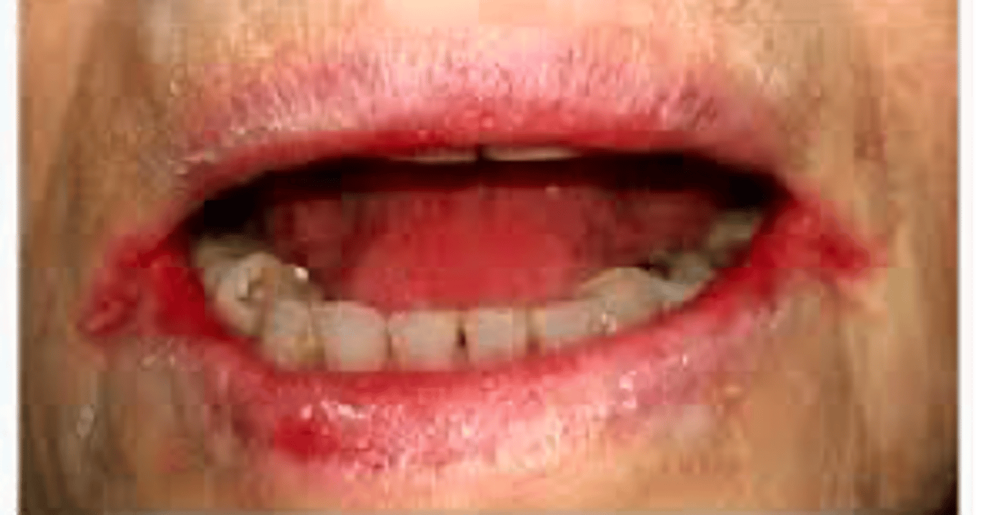 <p>What has the following characteristics?</p><p>- Dryness at the corners of the mouth leading skin breakdown, redness, crusting, fissures</p><p>- May become infected</p>
