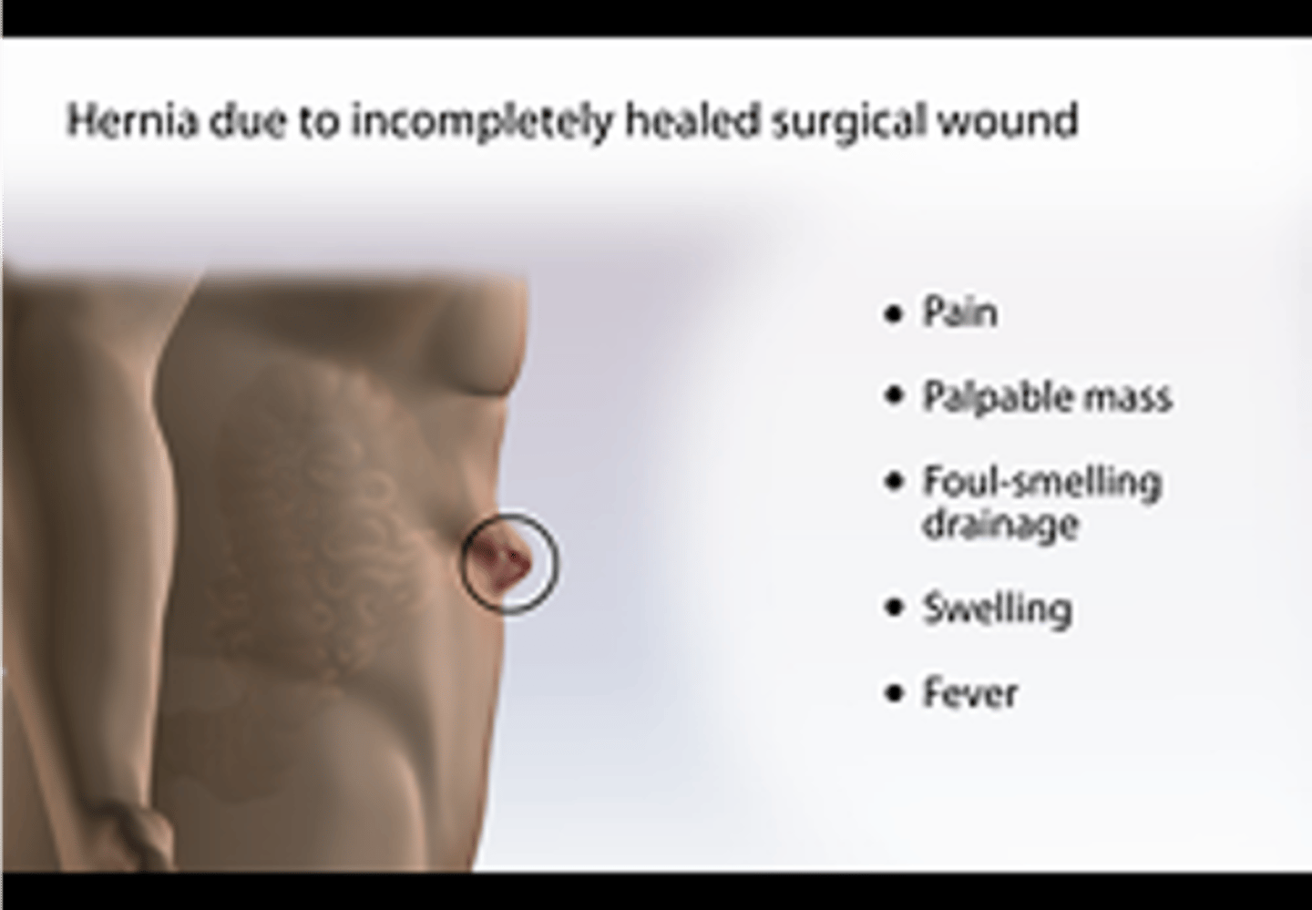 <p>incompletely healed surgical wound</p>