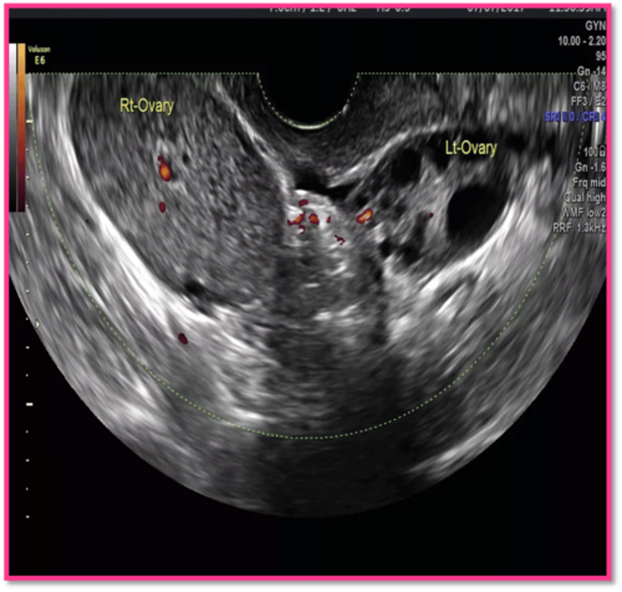<p>- enlarged ovary greater than 4 cm</p><p>- solid adnexal mass</p><p>- free fluid</p><p>- no flow</p>