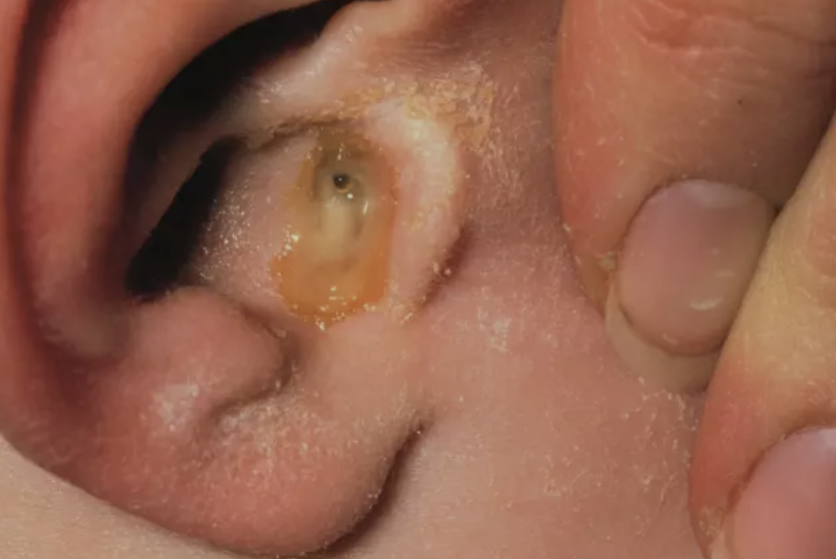 <p>Infection of the outer ear (ear canal)</p>