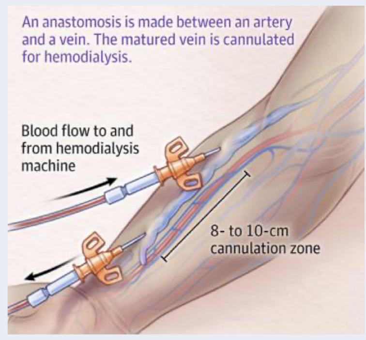 <p>preferred method for permanent access HD</p><p>native fistula: surgically created by connecting an artery and vein in the forearm</p><p>require 2-6 months for maturation before it can be used for HD</p><p>longest survival time of vascular access methods and lower rate of complications </p>