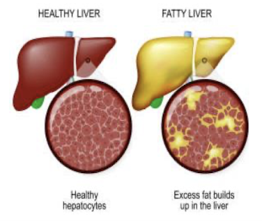<ul><li><p>accumulation of fat on liver </p></li><li><p>alcohol disrupts the liver’s ability to metabolize fats, leading to fat deposits </p></li><li><p>REVERSIBLE with abstinence </p></li></ul><p></p>