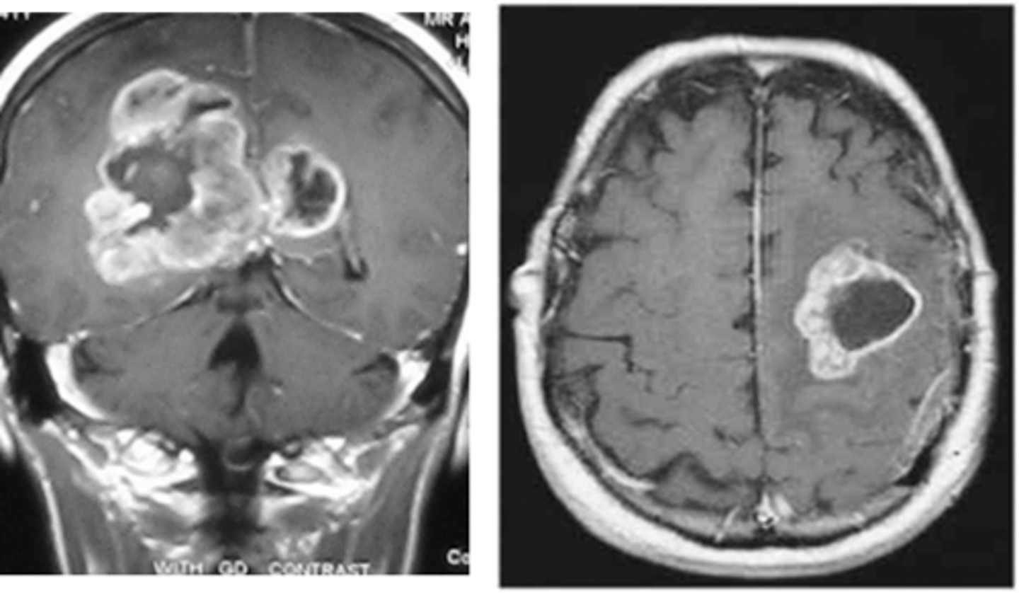 <p>MRI w/ gadolinium contrast; biopsy/histopathology</p>