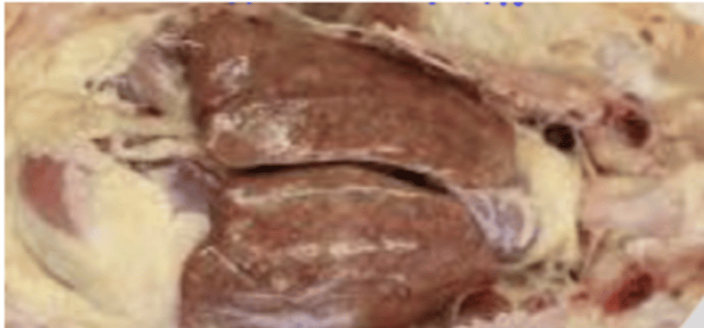 <p>why can E. coli cause pulmonary fibrosis? which strain is most likely to cause this?</p>