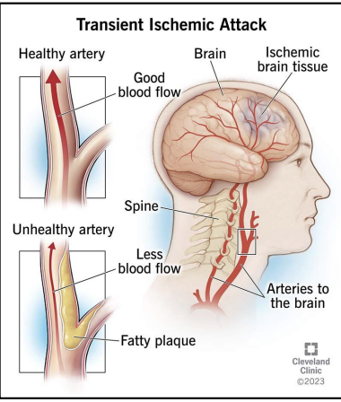 <p>Transient Ischemic Attacks TIA's</p>