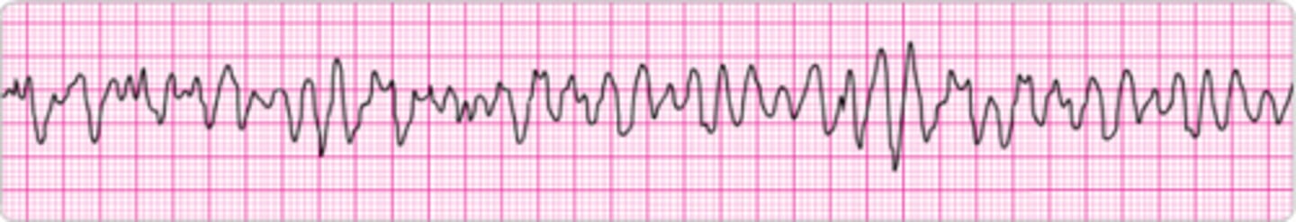 <p>Identify the rhythm.</p>