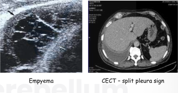 Split pleura sign