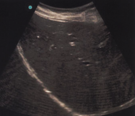 <ul><li><p><span style="background-color: transparent;">Strong ___ ___ from other nearby ___ devices can create ___ patterns</span></p></li><li><p><span style="background-color: transparent;">In the image, we see horizontal lines traveling through the image, especially at the bottom (far field)</span></p></li></ul><p></p>