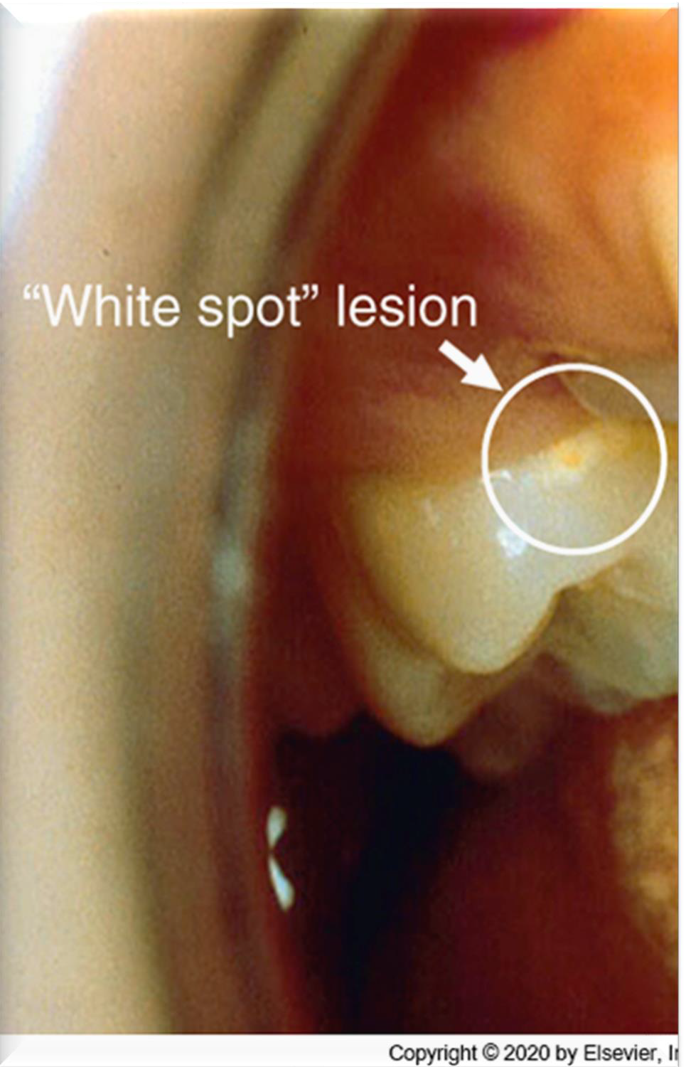 <p>Demineralized areas, also known as "white spot lesions."</p>