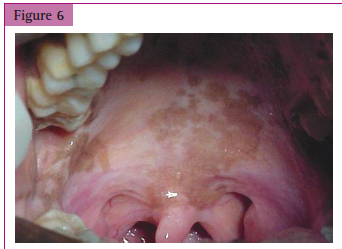 <p>Diffuse pigmentation of the palate in a patient with ___________.</p>