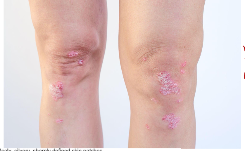 <p>Which 4 areas can you find this? What is it? Describe it</p><p>Which hand joints as well? </p><p>Bilateral or unilateral?</p>