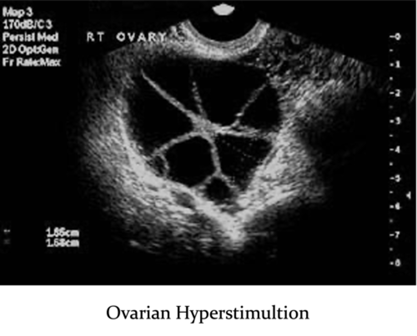 <p>1. ovarian hyperstimulation</p><p>2. multiple gestations (25% chance)</p><p>3. ectopic pregnancy</p>