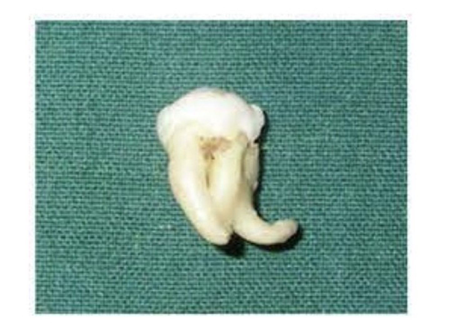 <p>An abnormal curve or bend in the root of a tooth. Usually discovered on a radiograph. May cause a problem if the tooth must be removed or a root canal performed.</p>
