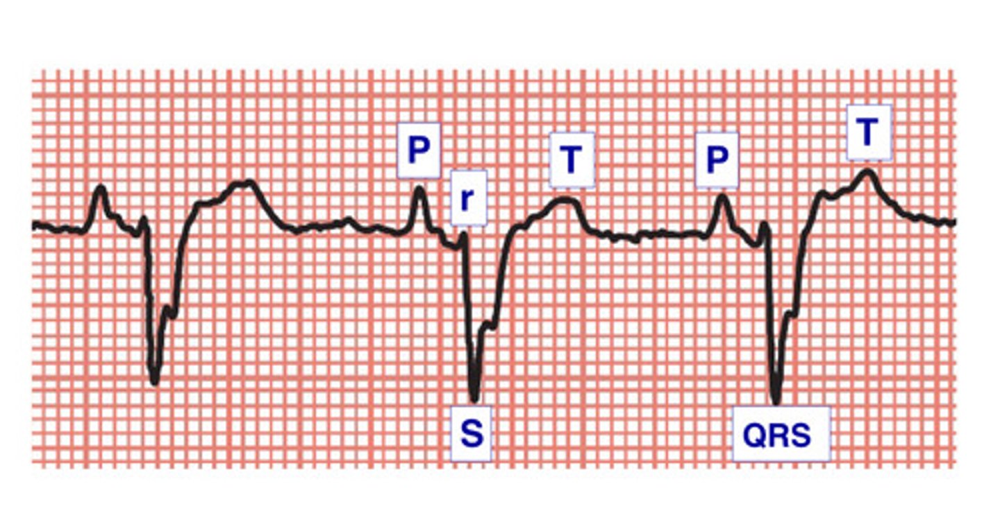<p>What is the broad lehman term when you see an ECG like this?</p>