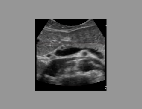 <p>which blood vessel courses anterior to the AO + posterior to SMA</p><p>.</p><p>a) inferior mesenteric vein</p><p>b) superior mesenteric vein </p><p>c) right renal vein</p><p>d) left renal vein </p>